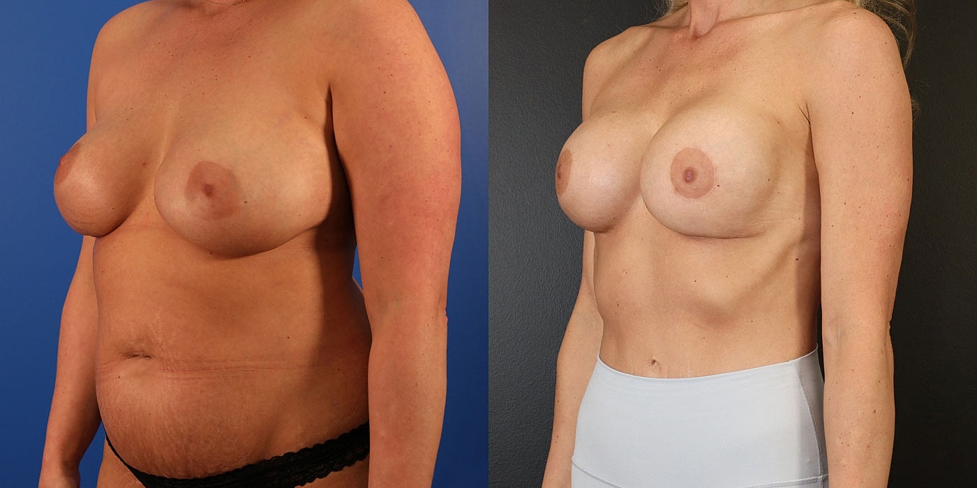 Before and after breast enhancement photos.