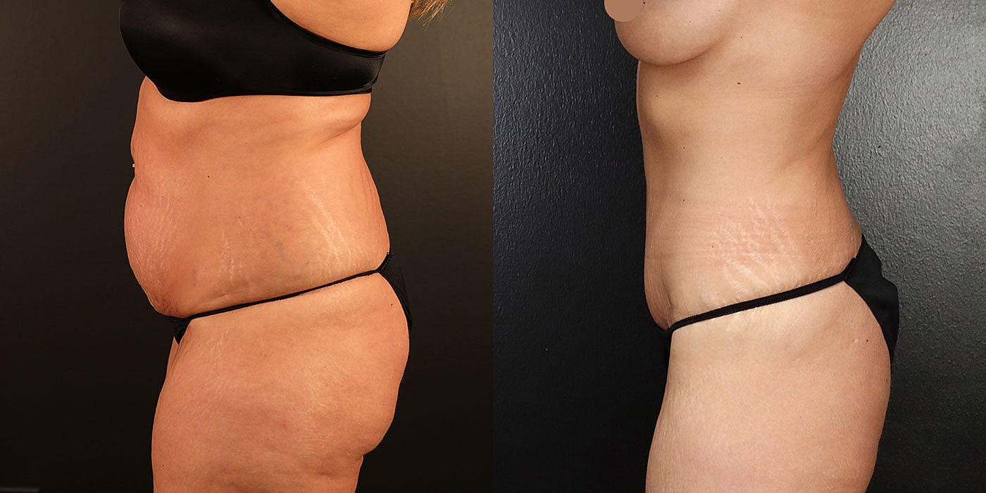 Before and after body transformation comparison.