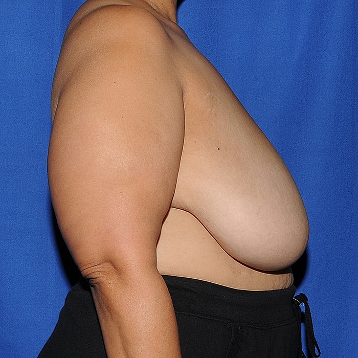 Breast Reduction Before & After