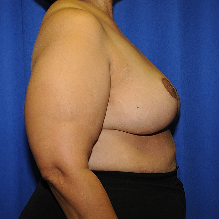 Breast Reduction Before & After