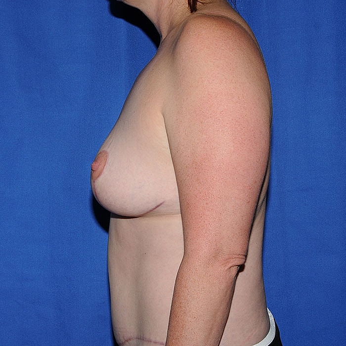 Breast Reduction Before & After