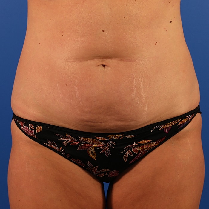 Abdominoplasty With Lipo Of Flanks Before & After