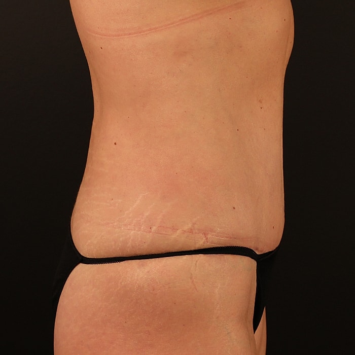 Abdominoplasty With Lipo Of Flanks Before & After