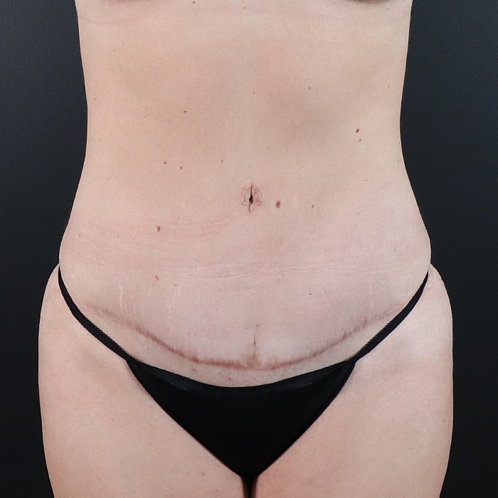 Abdominoplasty With Lipo Of Flanks Before & After