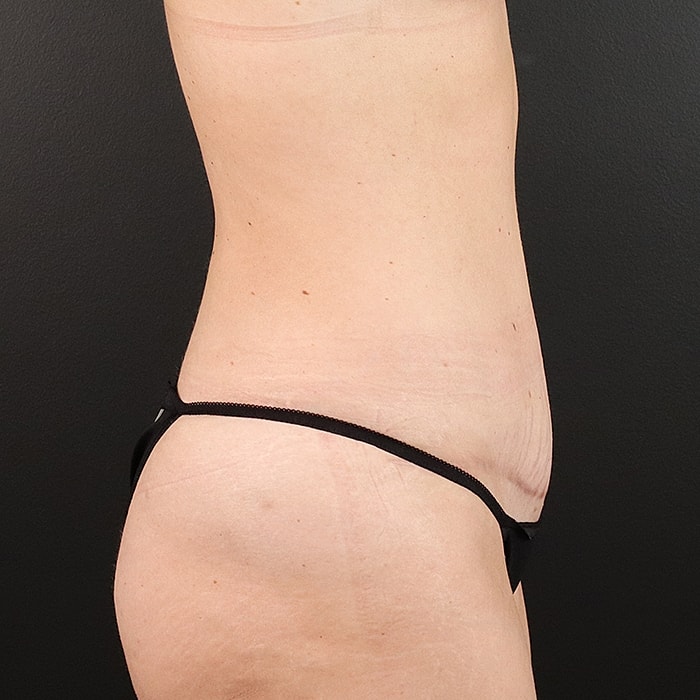 Abdominoplasty With Lipo Of Flanks Before & After