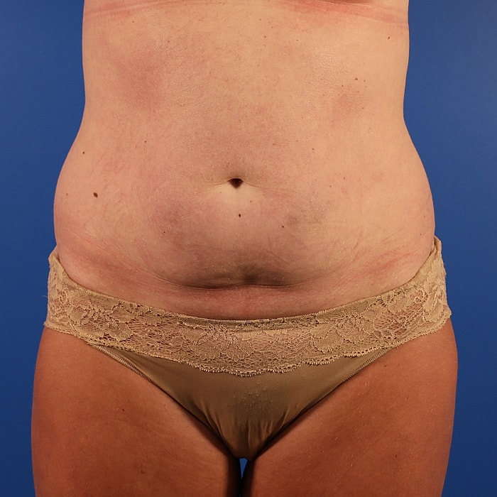 Abdominoplasty With Lipo Of Flanks Before & After