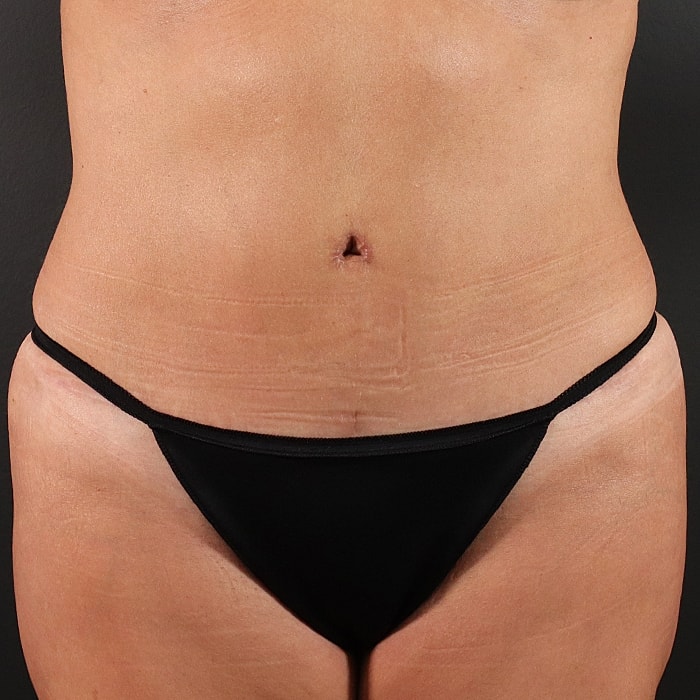 Abdominoplasty With Lipo Of Flanks Before & After