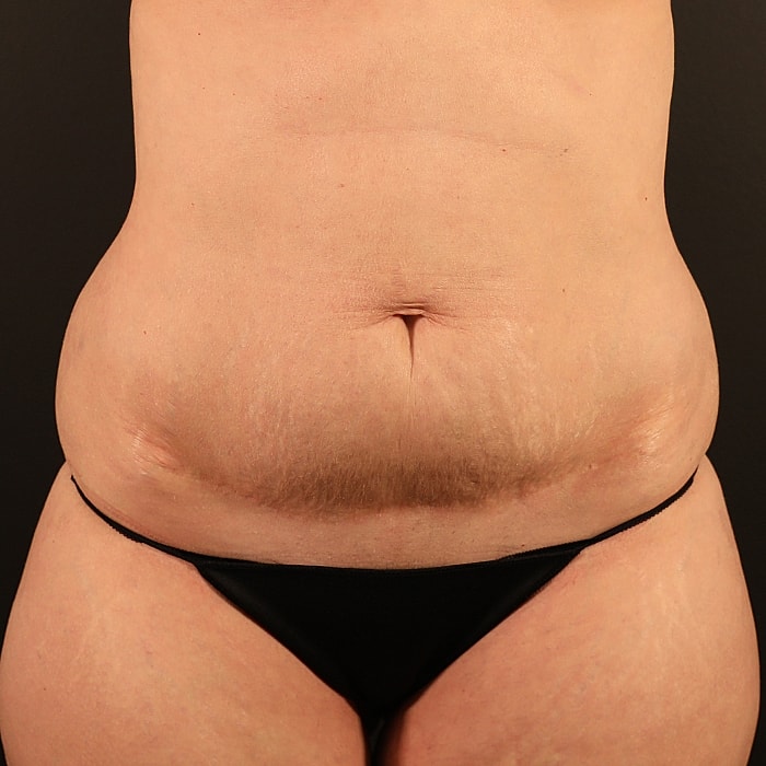 Abdominoplasty With Lipo Of Flanks Before & After