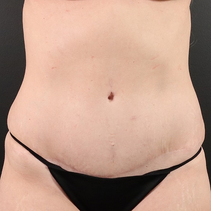Abdominoplasty With Lipo Of Flanks Before & After