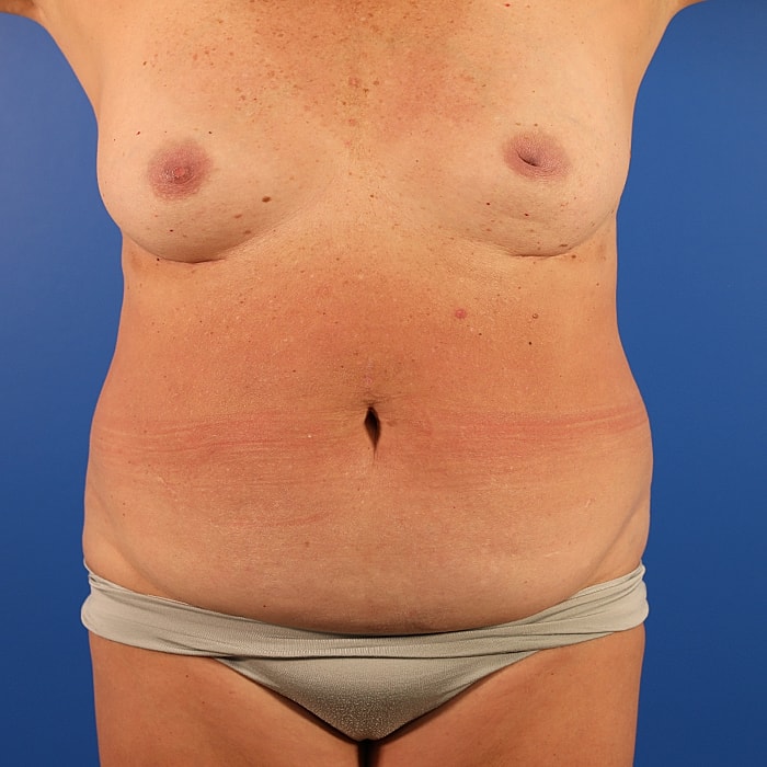 Abdominoplasty With Lipo Of Flanks Before & After