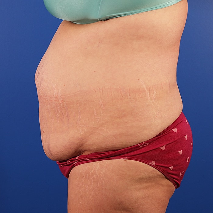 Abdominoplasty With Lipo Of Flanks Before & After