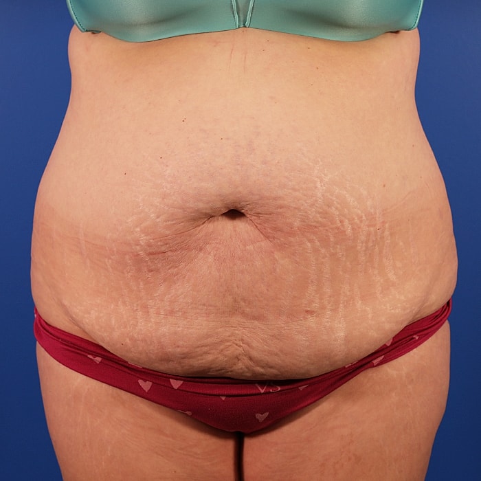 Abdominoplasty With Lipo Of Flanks Before & After