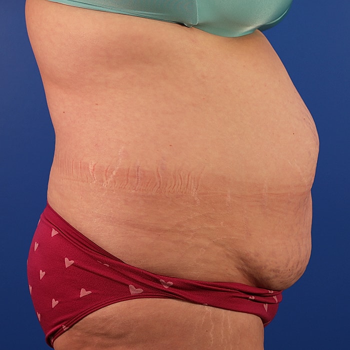 Abdominoplasty With Lipo Of Flanks Before & After