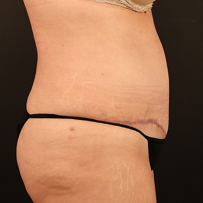 Abdominoplasty With Lipo Of Flanks Before & After