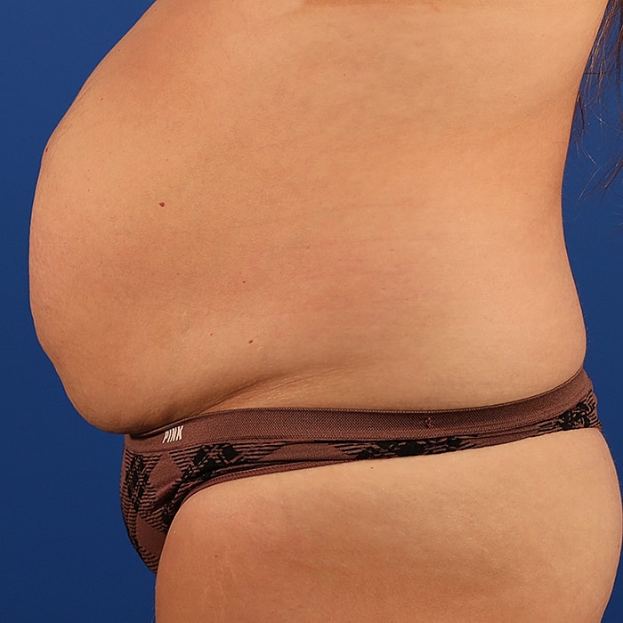 Abdominoplasty With Lipo Of Flanks Before & After