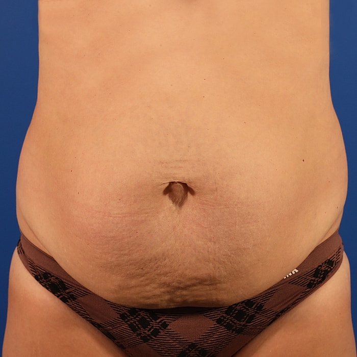 Abdominoplasty With Lipo Of Flanks Before & After