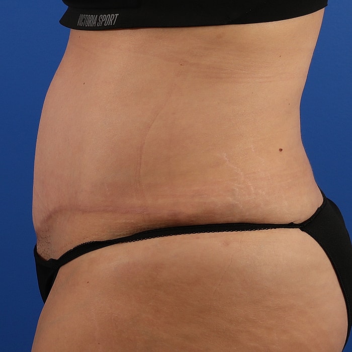 Abdominoplasty With Lipo Of Flanks Before & After