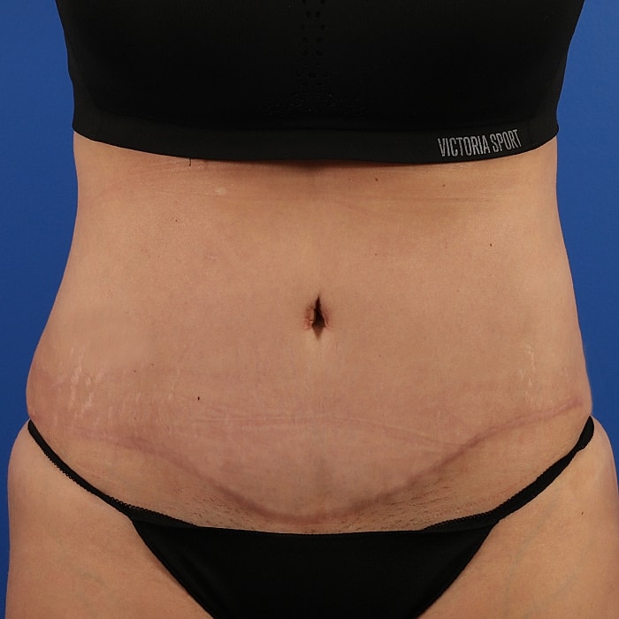 Abdominoplasty With Lipo Of Flanks Before & After