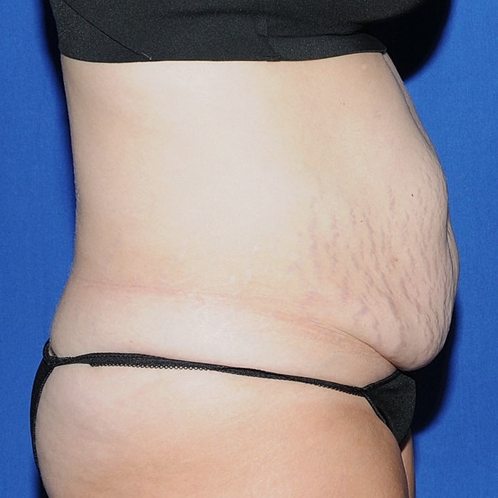 Abdominoplasty With Lipo Of Flanks Before & After