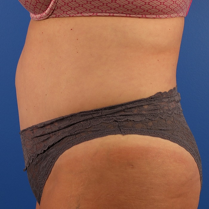 Abdominoplasty With Lipo Of Flanks Before & After