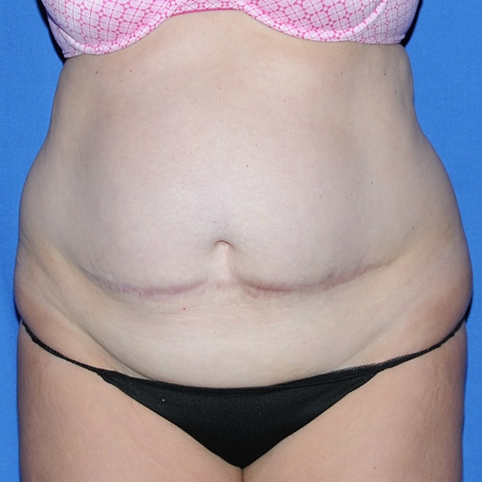Abdominoplasty With Lipo Of Flanks Before & After