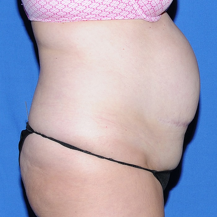 Abdominoplasty With Lipo Of Flanks Before & After
