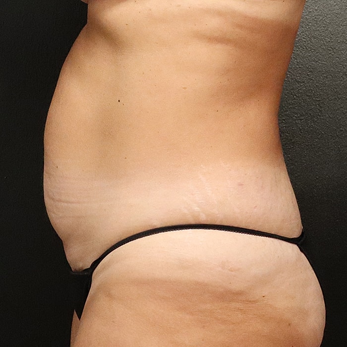 Abdominoplasty With Lipo Of Flanks Before & After
