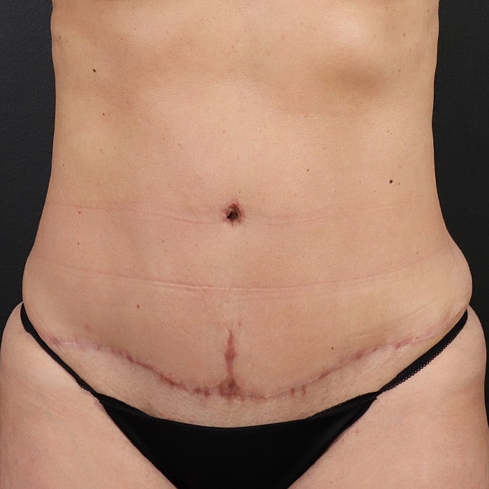 Abdominoplasty With Lipo Of Flanks Before & After