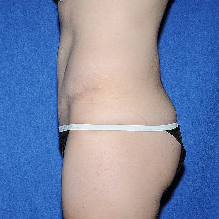 Abdominoplasty With Lipo Of Flanks Before & After
