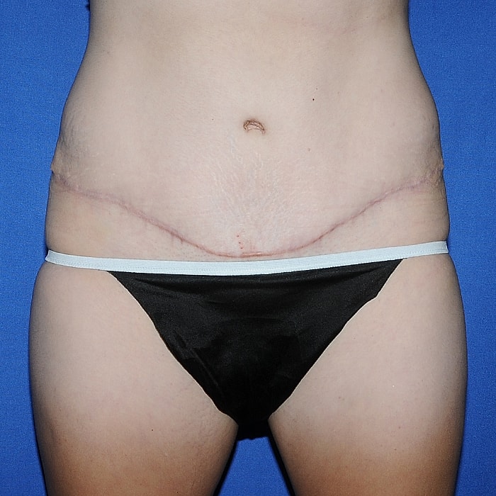 Abdominoplasty With Lipo Of Flanks Before & After