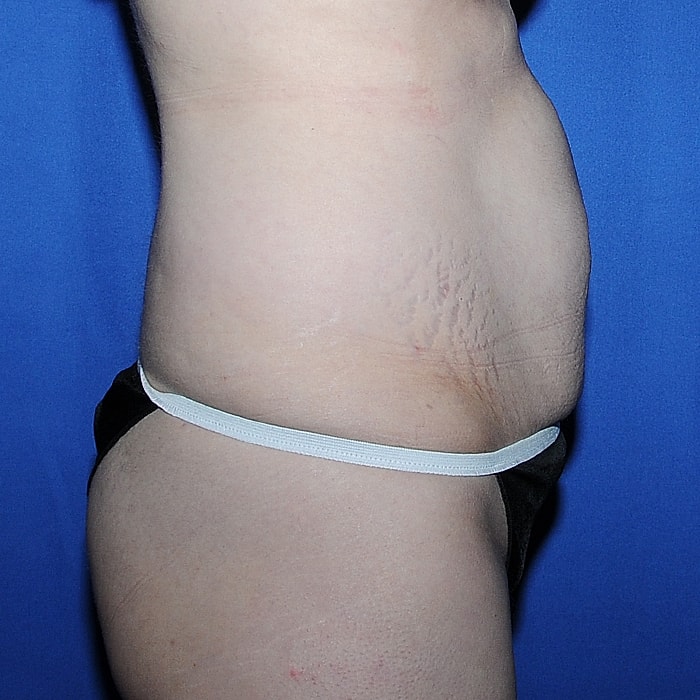 Abdominoplasty With Lipo Of Flanks Before & After