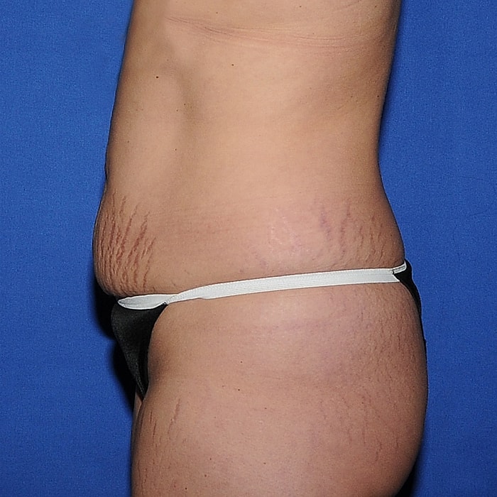 Abdominoplasty With Lipo Of Flanks Before & After