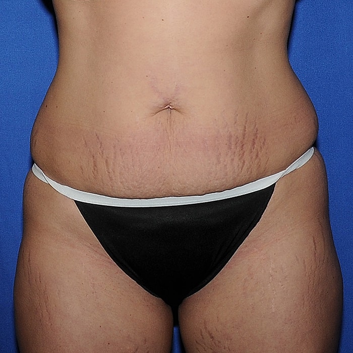 Abdominoplasty With Lipo Of Flanks Before & After