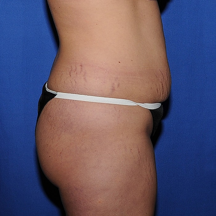 Abdominoplasty With Lipo Of Flanks Before & After