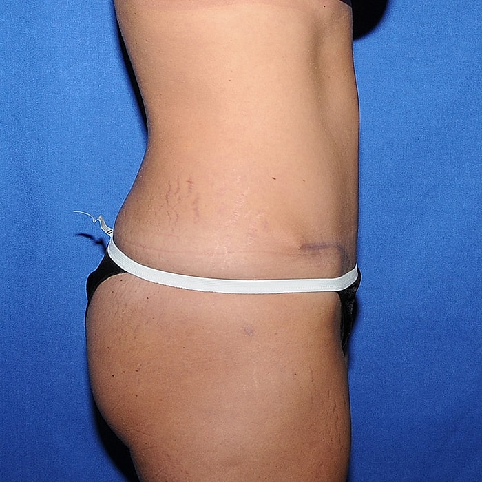Abdominoplasty With Lipo Of Flanks Before & After