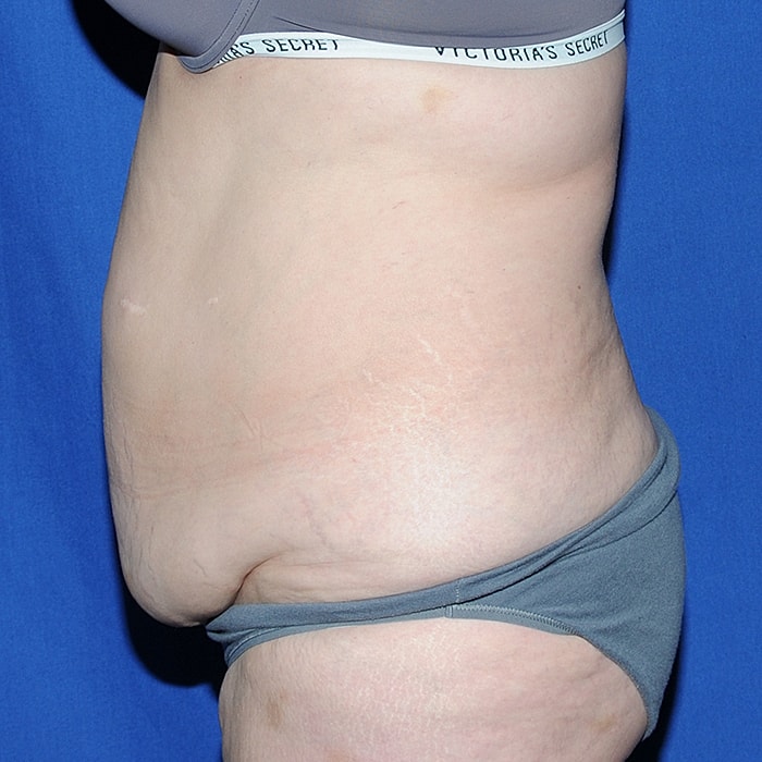 Abdominoplasty With Lipo Of Flanks Before & After
