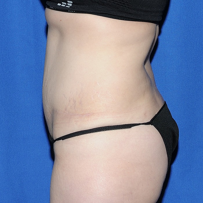 Abdominoplasty With Lipo Of Flanks Before & After