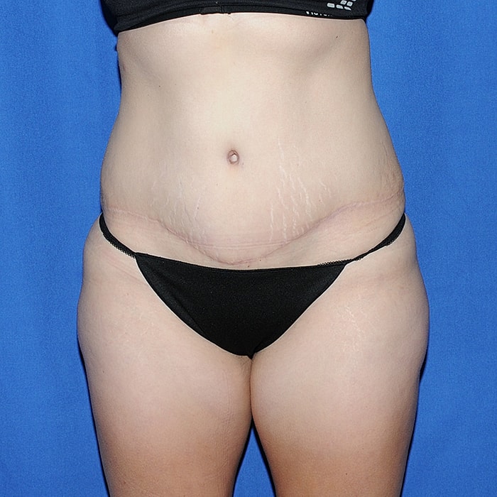 Abdominoplasty With Lipo Of Flanks Before & After