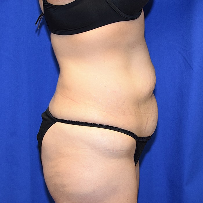 Abdominoplasty With Lipo Of Flanks Before & After