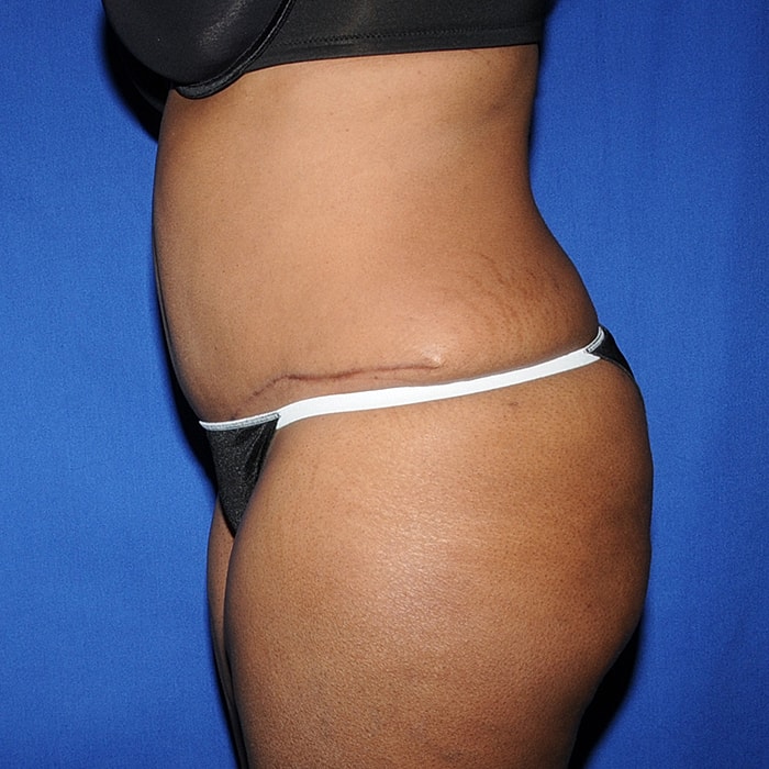 Abdominoplasty With Lipo Of Flanks Before & After