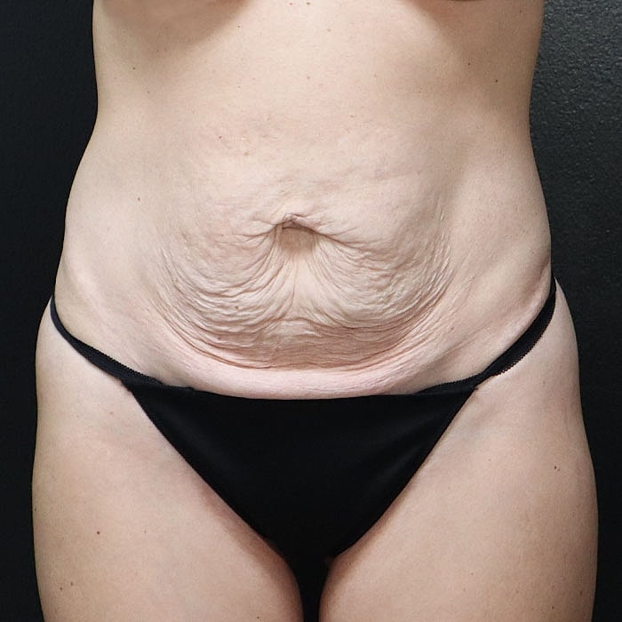 Abdominoplasty With Lipo Of Flanks Before & After