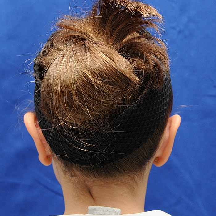 Otoplasty Before & After