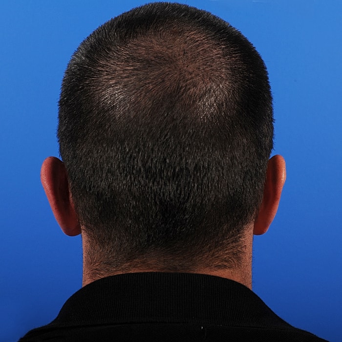 Otoplasty Before & After