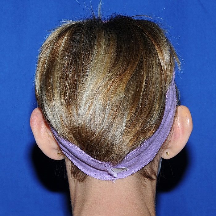 Otoplasty Before & After