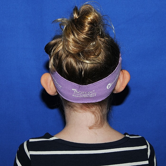 Otoplasty Before & After