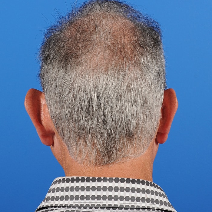 Otoplasty Before & After