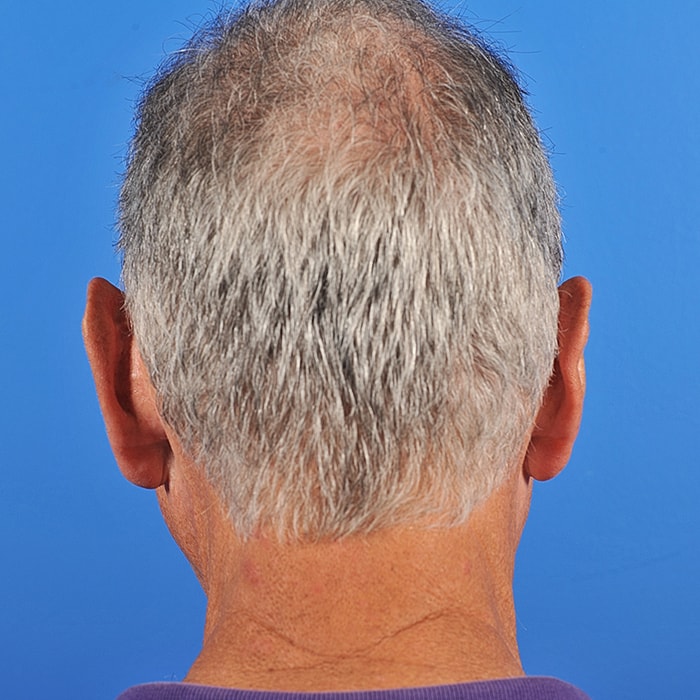 Otoplasty Before & After