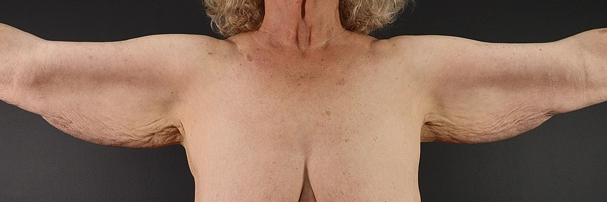 Brachioplasty Before & After