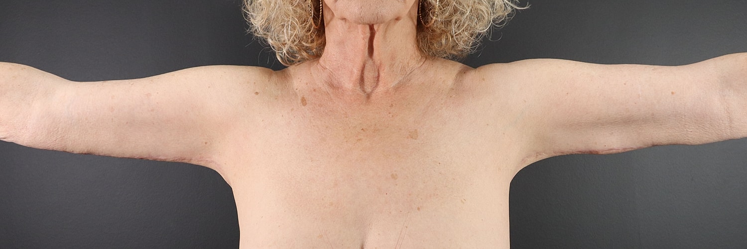 Brachioplasty Before & After