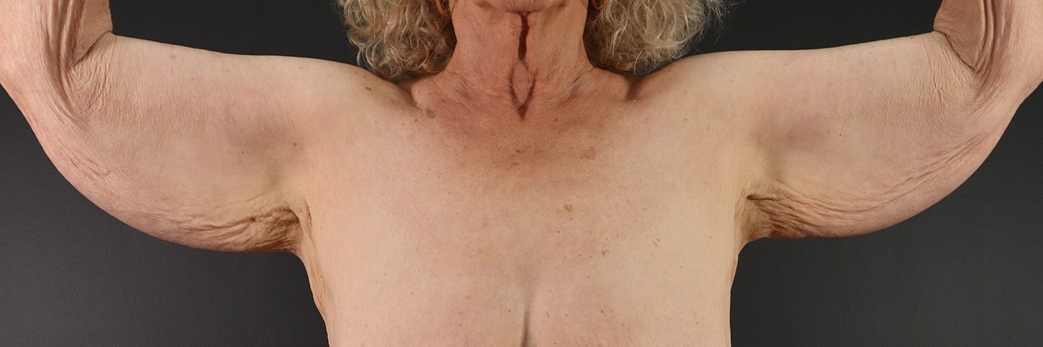 Brachioplasty Before & After